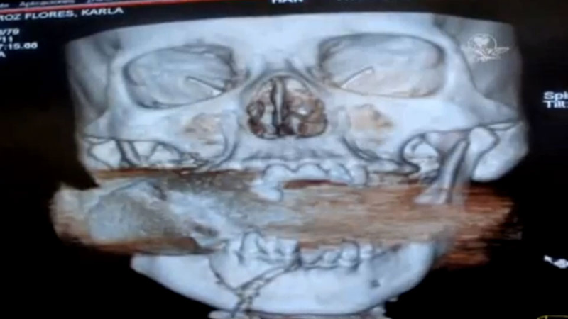 Illustration for article titled This Woman Had a Live Fragmentation Grenade Stuck Inside Her Face